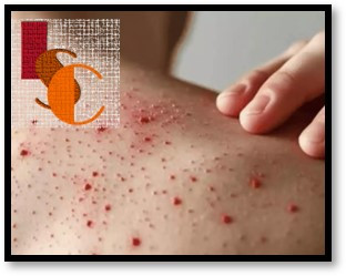 Refuerzan vigilancia de sarampión en hospitales y plataformas petroleras.